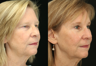 Brow Lift before and after photo