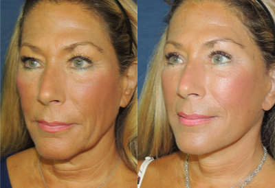 Facelift before and after photo