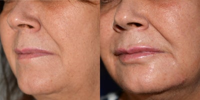 Lip Fillers before and after photo