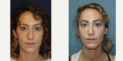 Rhinoplasty before and after photo