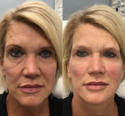 Voluma before and after photo