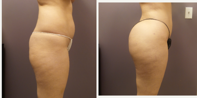 Brazilian Butt Lift before and after photo