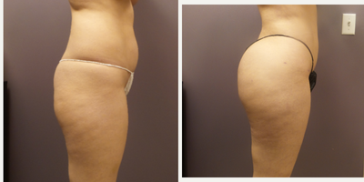 Brazilian Butt Lift before and after photo
