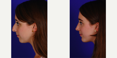 Chin Implant before and after photo