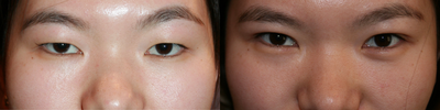 Double Eyelid Surgery before and after photo