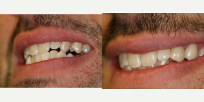 Invisalign before and after photo