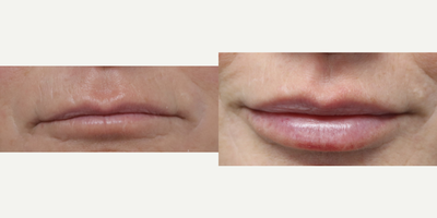 Lip Fillers before and after photo