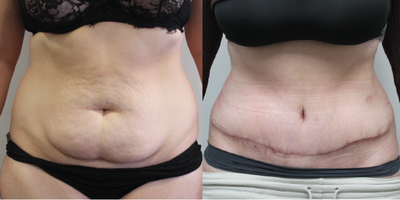 Mommy Makeover before and after photo