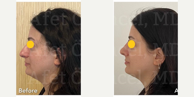 Rhinoplasty before and after photo