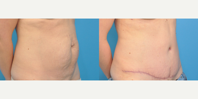 Tummy Tuck before and after photo