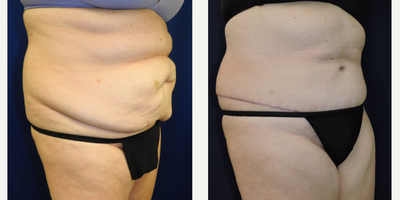 Tummy Tuck before and after photo