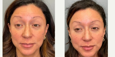 Botox before and after photo