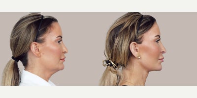 Neck Lift before and after photo