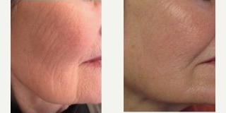 Profound RF before and after photo