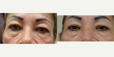 Restylane before and after photo