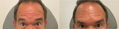 Botox before and after photo