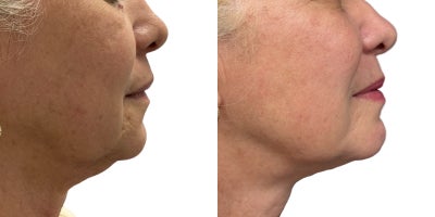 Endolift before and after photo