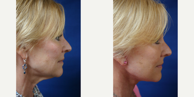 Facelift before and after photo