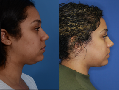 Liposculpture before and after photo
