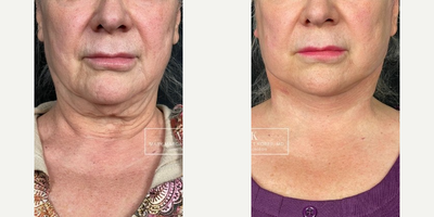 Lower Facelift before and after photo
