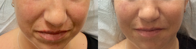 Radiesse before and after photo