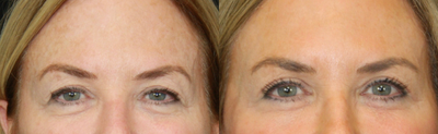 Brow Lift before and after photo