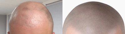 Scalp Micropigmentation before and after photo