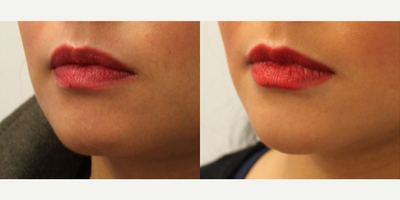 Dermal Fillers before and after photo