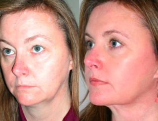Facelift before and after photo