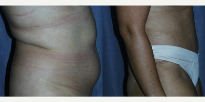 Tummy Tuck before and after photo