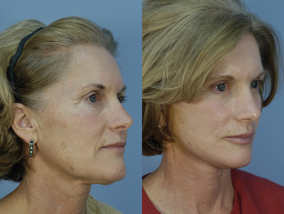 Mini Facelift before and after photo