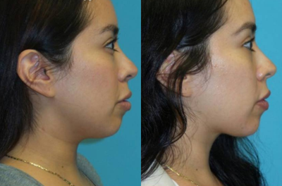 Ultherapy before and after photo