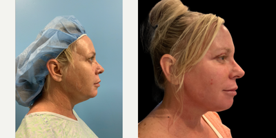 before and after image