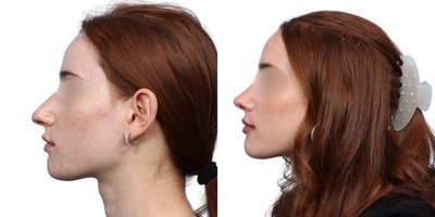 Rhinoplasty before and after photo