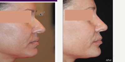Dermal Fillers before and after photo
