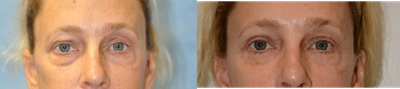 Eyelid Surgery before and after photo