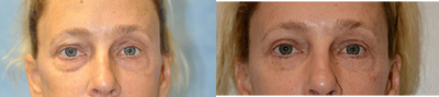 Eyelid Surgery before and after photo