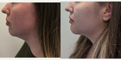 Genioplasty before and after photo