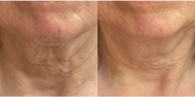 Sofwave before and after photo
