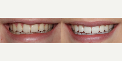 Teeth Whitening before and after photo