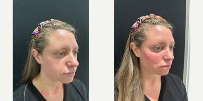 Cheek Fillers before and after photo