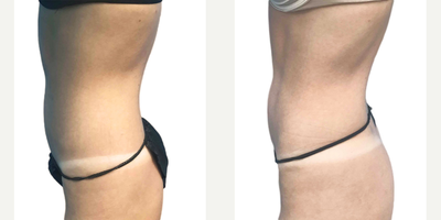 Emsculpt before and after photo