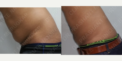 Liposculpture before and after photo