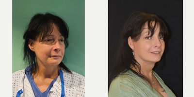 Neck Lift before and after photo