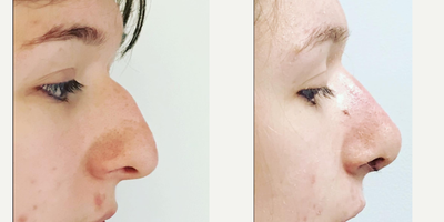 Rhinoplasty before and after photo