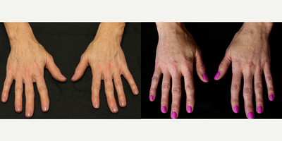 Radiesse before and after photo
