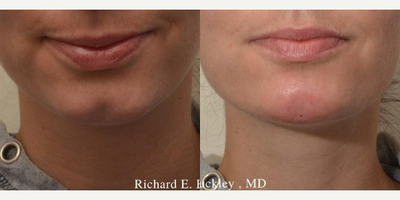 Restylane before and after photo