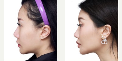 Revision Rhinoplasty before and after photo