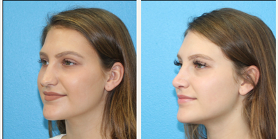 Rhinoplasty before and after photo