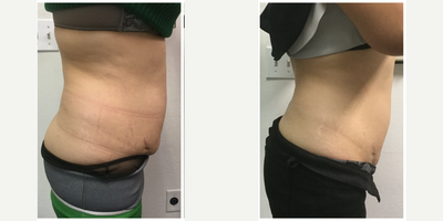 Vanquish before and after photo
